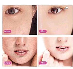 Skin Mole And Wart Removal Pen