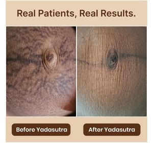 stretch marks cream Unused