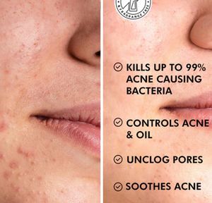 Anti Acne Pads