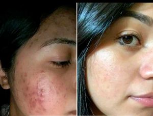 Pimple Jel
