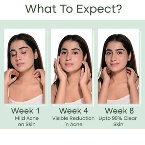 Anti Acne Face Wash Cleanser-150ML For All Skin