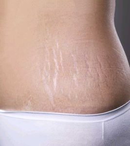 DermaOuch Bye Stretch Marks Cr