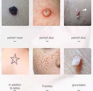 Skin Mole And Wart Removal Pen