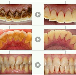 Electronic Tooth Stain Cleaner