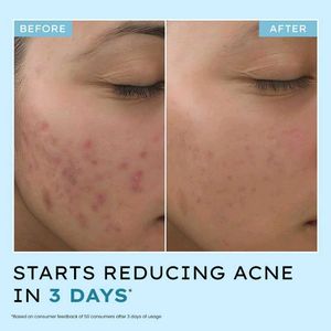 Hyphen Acne Defence Face Serum