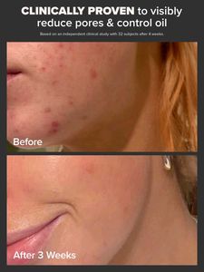 Paula&#39;s Choice 2% BHA Liquid Exfoliant