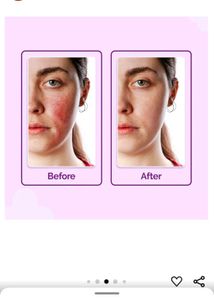 The Dermaco Hypochlorous Anti Acne Spray