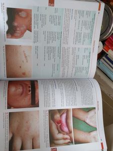 Op Ghai Textbook Of Paediatrics