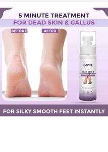 Sanfe Dead Skin &amp; Callus Remover Spray Few Minutes