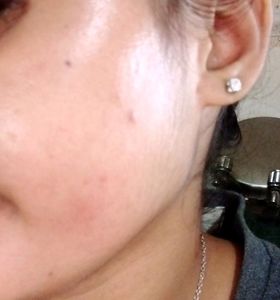 Benzoyl Peroxide Gel IP 2.5%