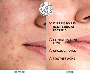 Salicylic Acid Serum Clear Skin Acne Pads