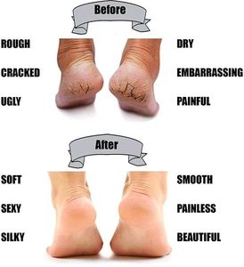 Silicone Heel Protector