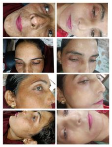 Pigmentation Cream Kit