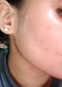 Benzoyl Peroxide Gel IP 2.5%