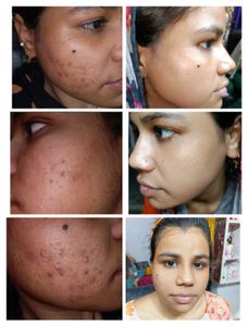 Pigmentation Cream Kit