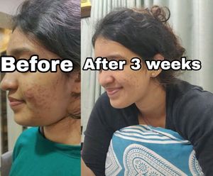 Pimple Clear In 3 Days!! 100% Natural &amp; Ayurvedic