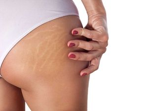 DermaOuch Bye Stretch Marks Cr
