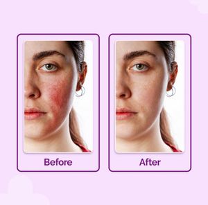 The Derma Co Hypochlorous Anti Acne Hydrating Spra