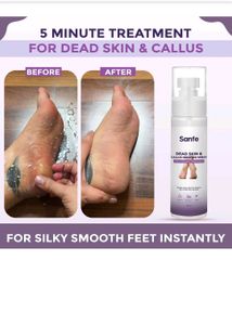 Sanfe Dead Skin &amp; Callus Remover Spray Few Minutes