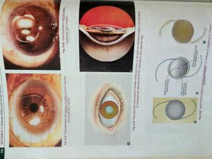 AK KHURANA -ophthalmology 8th edition