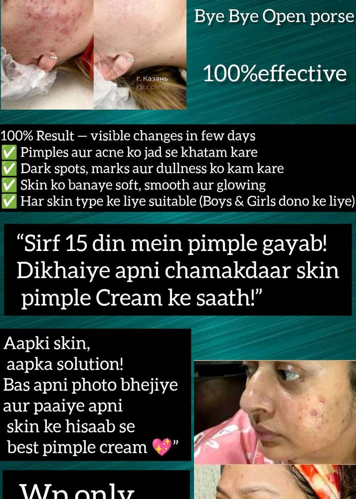 Effective Pimple Cream - 20 Days!